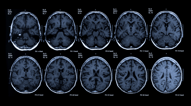 A nutrient combination to help preserve cognition